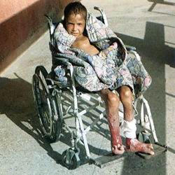A kid wounded by US bomb