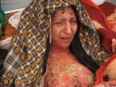 گلبر که توسط شوهرش آتش زده شده