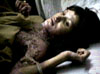 The woman who was burnt